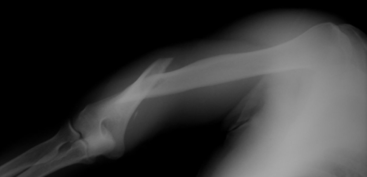 Broken Bones | Ministry127